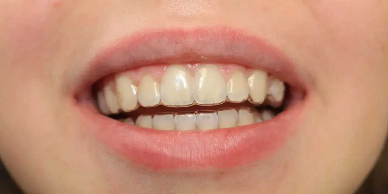 Zbliżenie na uśmiech z widocznymi przezroczystymi nakładkami Invisalign na zębach.
