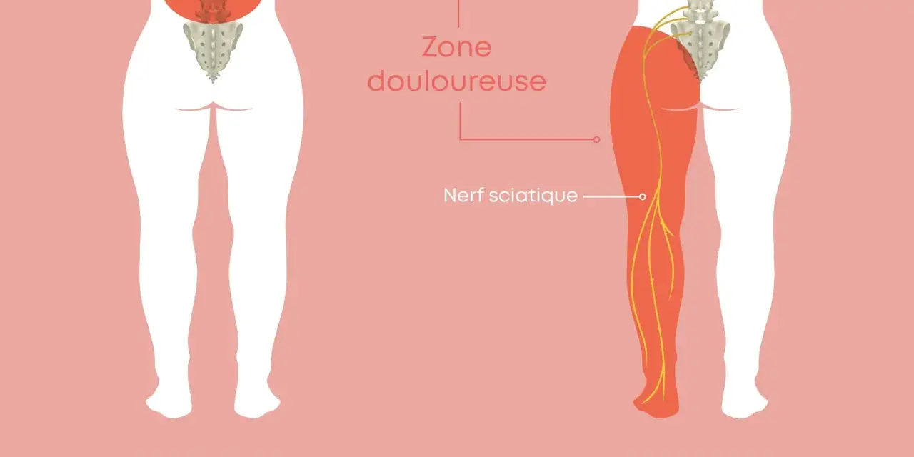 Illustration comparant le lumbago et la sciatique. La sciatique, combien de temps dure-t-elle ? Le nerf sciatique est montré irradiant dans la jambe.