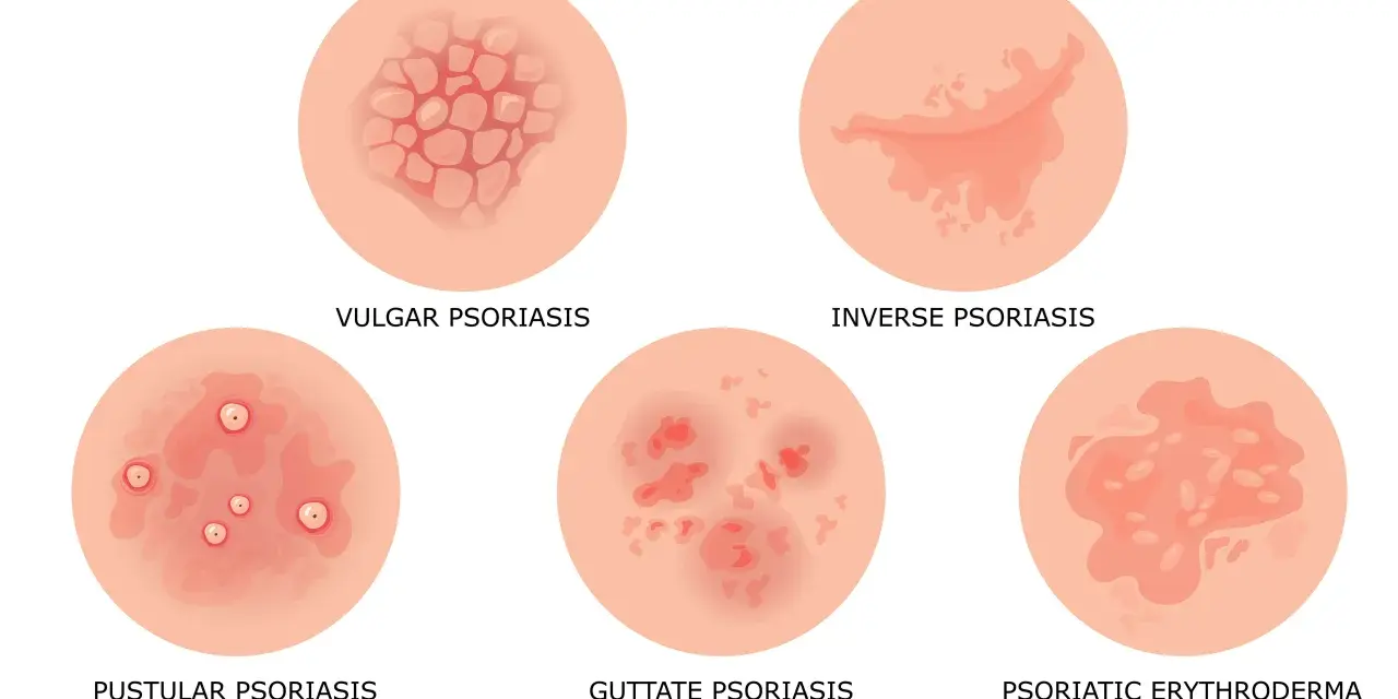 Ilustracja pokazuje różne typy łuszczycy: łuszczycę zwykłą, łuszczycę odwróconą, łuszczycę krostkową, łuszczycę plamistą i łuszczycę erytrodermiczną.