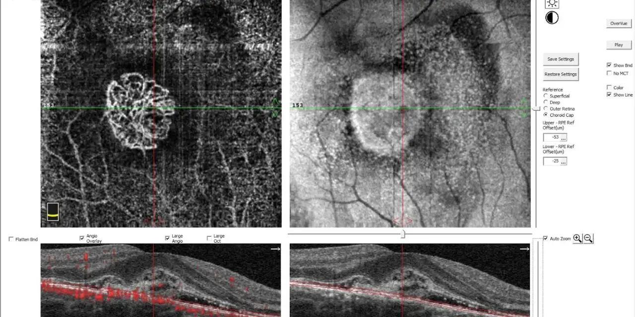 Immagine OCT di un occhio destro, mostra un ispessimento retinico con neovascolarizzazione coroideale, possibile causa di problemi visivi.