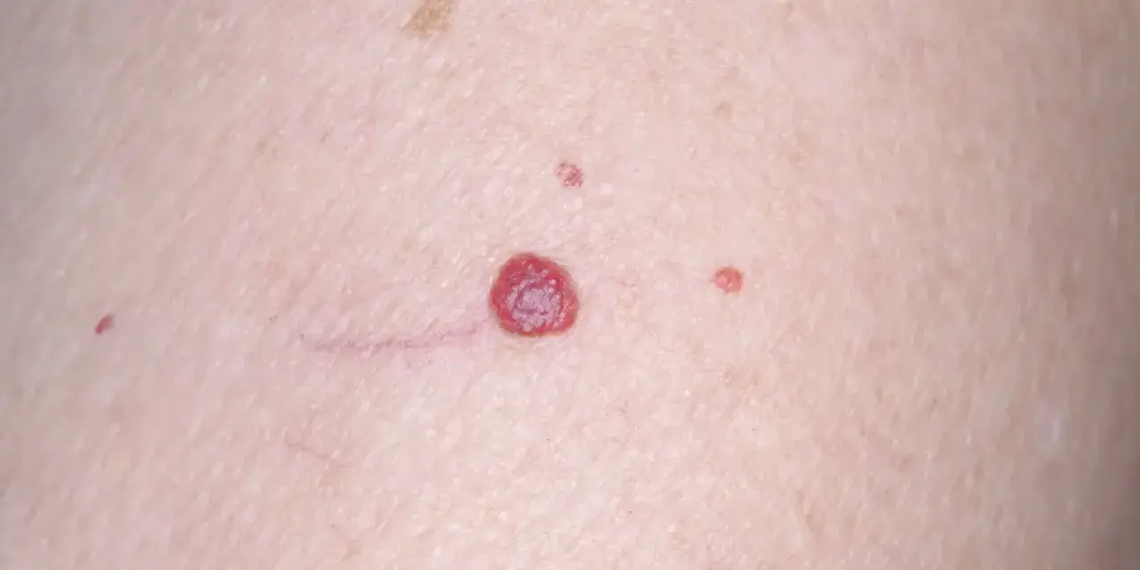 Piel con varios lunares rojos de diferentes tamaños, algunos pequeños y otros más prominentes, junto a finas venas.