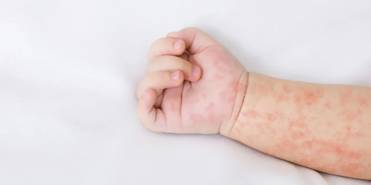 Jak wygląda alergia u niemowlaka? Objawy, które musisz znać