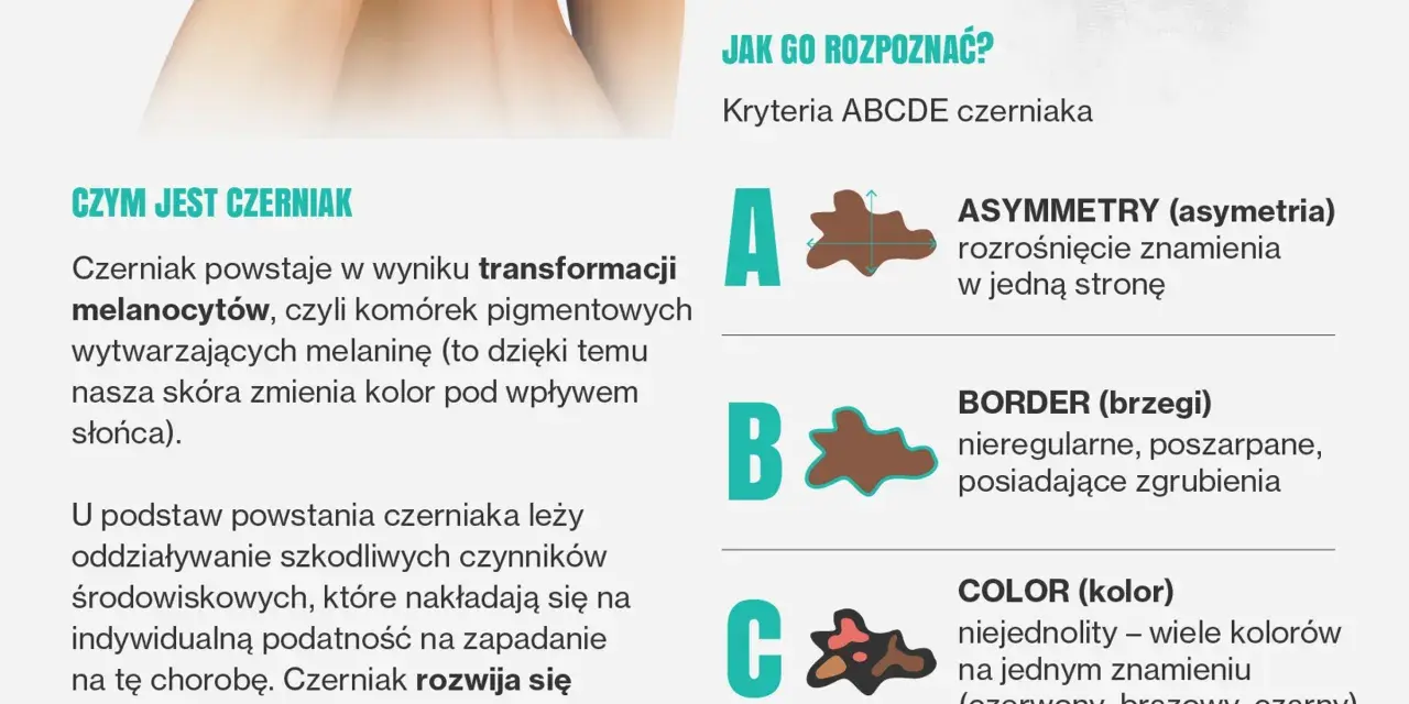 Jak rozpoznać czerniaka? Poznaj kryteria ABCDE: asymetria, brzegi, kolor, średnica i ewolucja znamienia. Dbaj o swoją skórę!