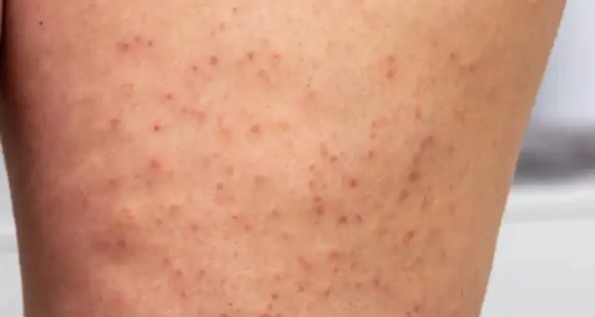 Eingewachsenes Haar am Bein: Ursachen, Behandlung und Vorbeugung