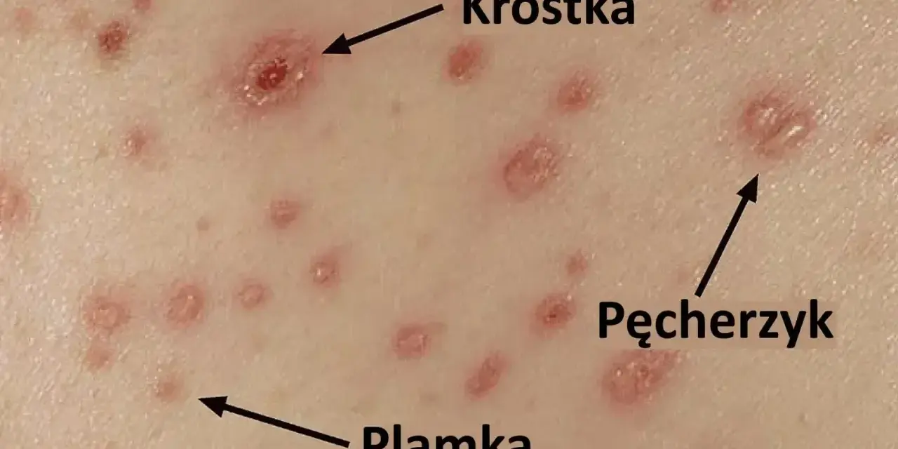 Początki ospy: czerwone plamki, krostki i pęcherzyki na skórze.