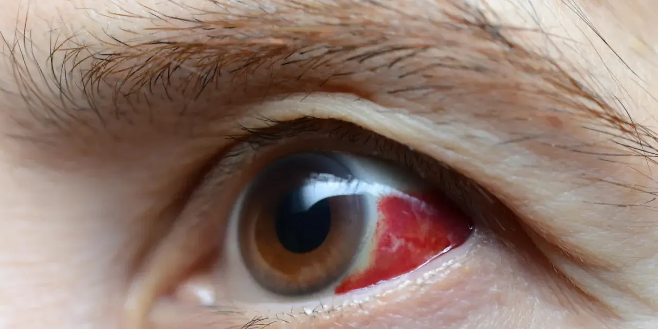 Occhio con forte arrossamento, possibile sintomo di complicanze del diabete.
