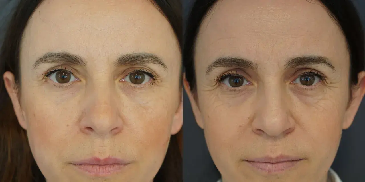 Nahaufnahme zweier Gesichter, die die Entwicklung von reifer Haut ab wann zeigen. Falten um die Augen und auf der Stirn sind sichtbar.