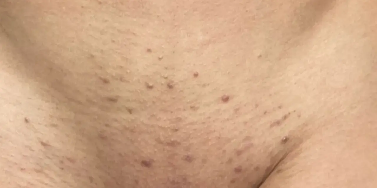 Red bumps and irritation on the skin, indicative of folliculitis and a histamine reaction after waxing.