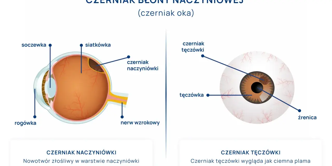 Schemat oka z zaznaczonym czerniakiem błony naczyniowej. Pokazuje czerniaka naczyniówki pod siatkówką i czerniaka tęczówki.