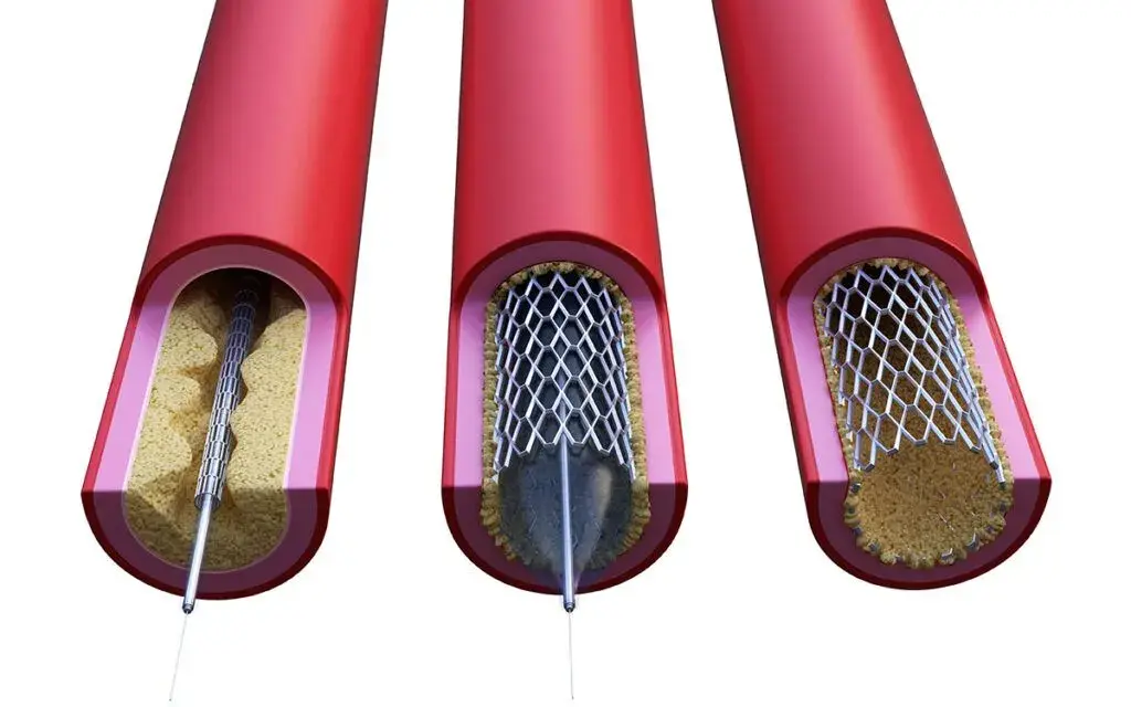 Zatkany stent objawy: niebezpieczne sygnały, które musisz znać