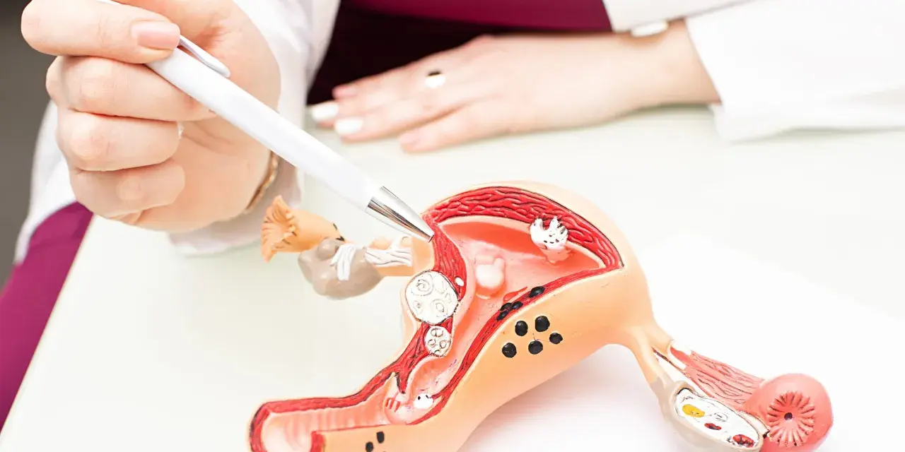 Lekarz wskazuje na model macicy, gdzie widoczny jest polip endometrialny.