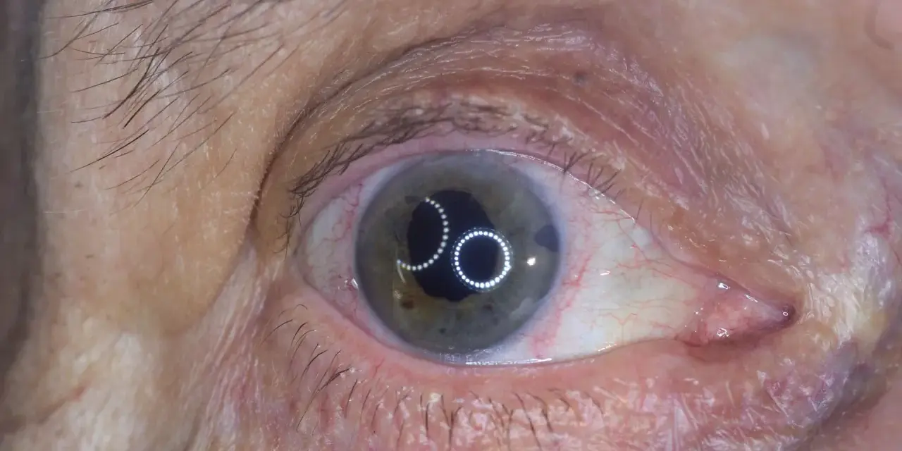 Occhio con iride verde-grigia e riflessi luminosi. Si nota una piccola apertura nell'iride, tipica di un intervento di iridectomia cos'è.