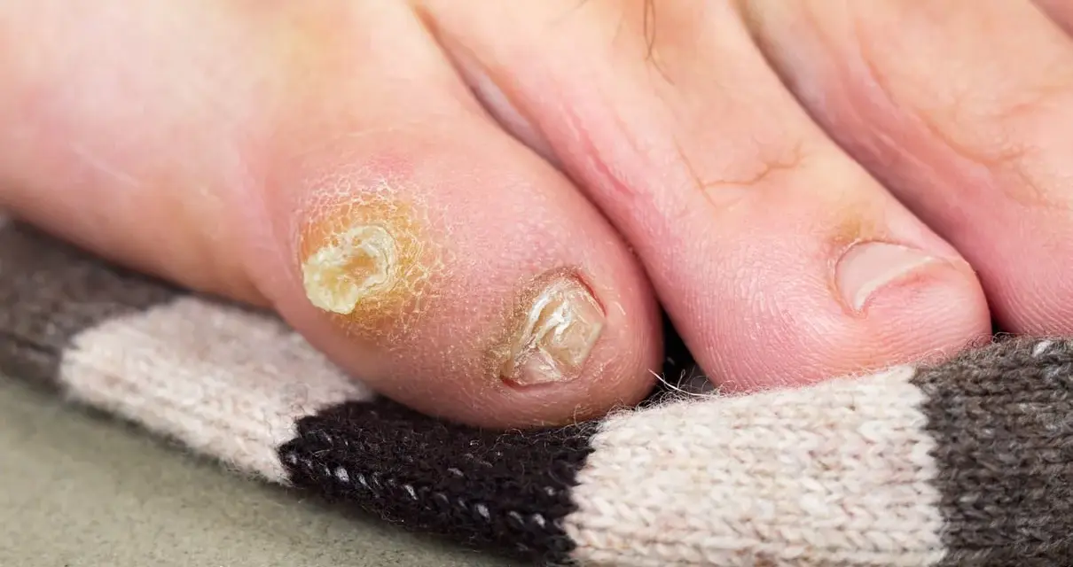 Un oignon au pied, un remède de grand-mère à base d'oignon pourrait aider. Gros plan sur un orteil avec un cor et un ongle abîmé.
