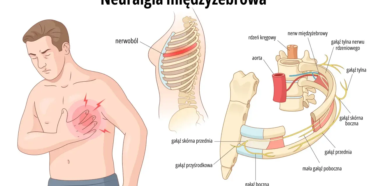 Ilustracja przedstawia mężczyznę z bólem w klatce piersiowej, wskazującym na neuralgia potyliczna objawy. Pokazuje unerwienie żeber i kręgosłupa.