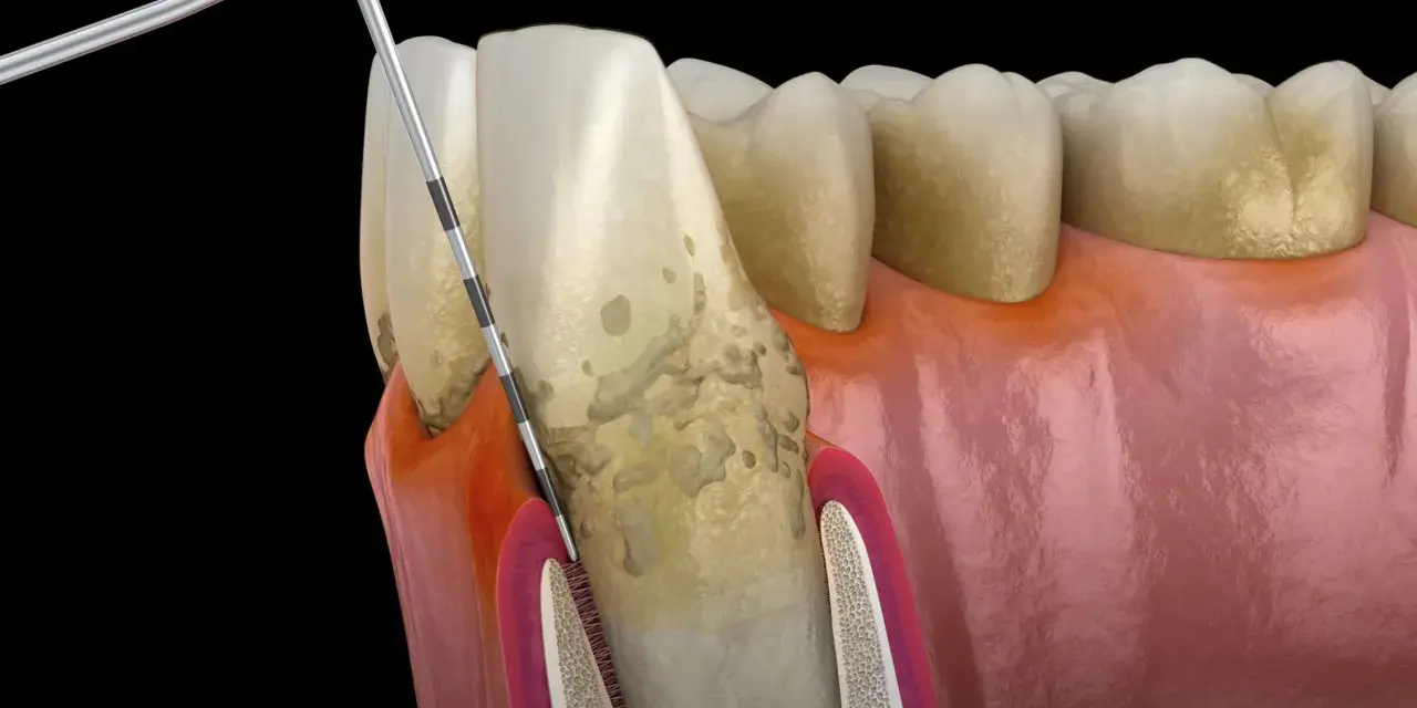 Model stomatologiczny pokazujący postępujące choroby dziąseł, z widocznym kamieniem nazębnym i narzędziem dentystycznym.