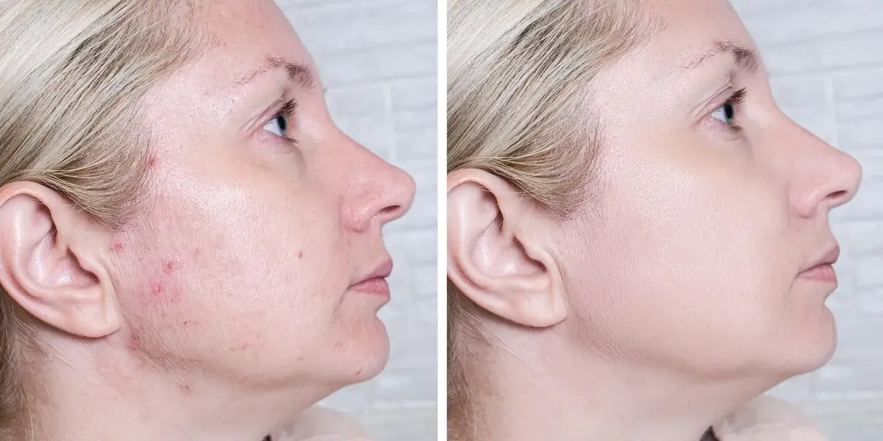 Przed i po: skóra z niedoskonałościami i zaczerwienieniami (acne) po zastosowaniu produktu, który wyrównał koloryt i wygładził cerę.