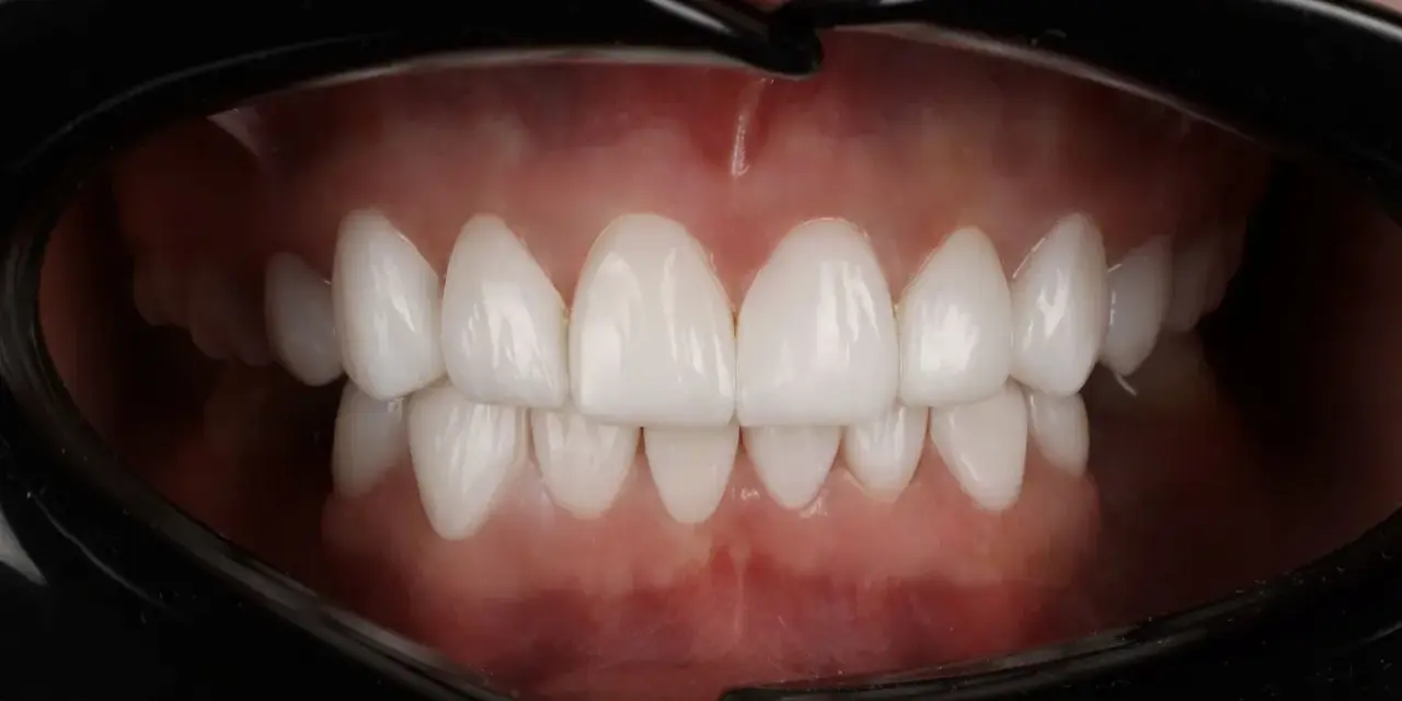 Piękne, białe zęby po zabiegu dental bonding. Uśmiech jak z reklamy!