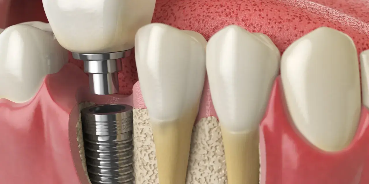 Przekrój szczęki pokazujący implant zębowy i koronę. Dowiedz się, ile kosztuje wstawienie zęba 4.