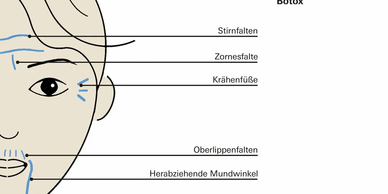 Schema zeigt typische Anwendungsgebiete für Botox, z.B. Stirnfalten, Zornesfalten, Krähenfüße.