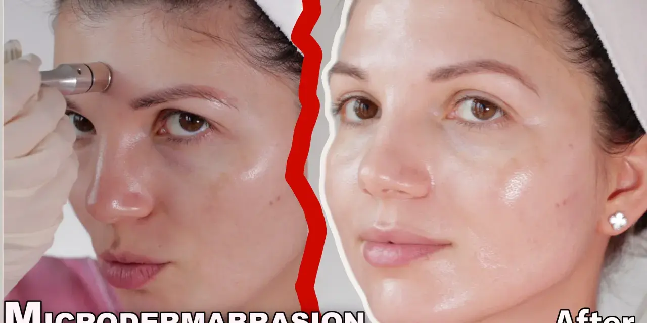 Woman using a microdermabrasion device on her forehead. Learn how to clean microdermabrasion tips for best results.