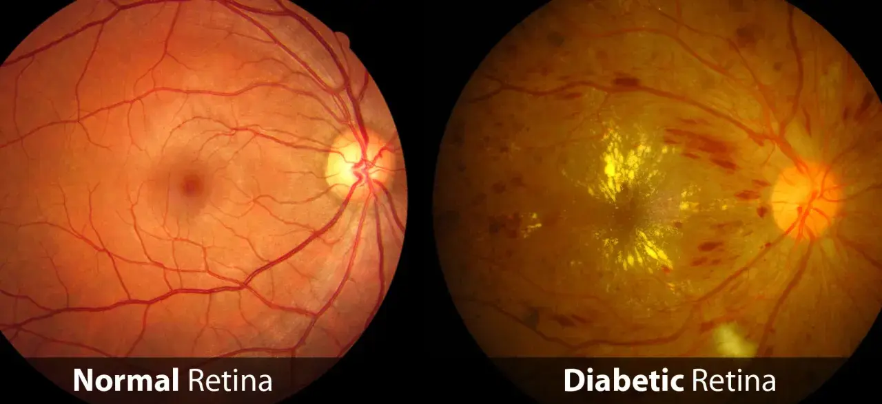 Confronto tra retina sana e retina diabetica: la seconda mostra emorragie e depositi gialli, sintomi della retinopatia diabetica.