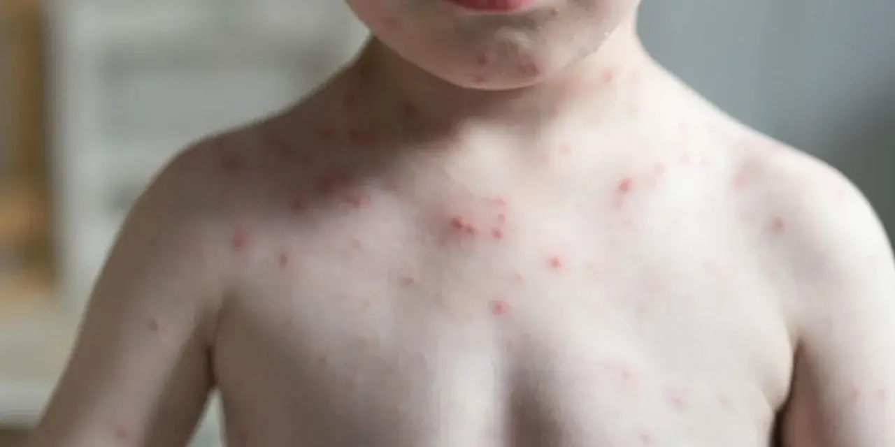 Kind mit roten Pusteln am Oberkörper und Hals. Die Haut wirkt blass, was Fragen aufwirft: "Warum ist mein Kind so blass?