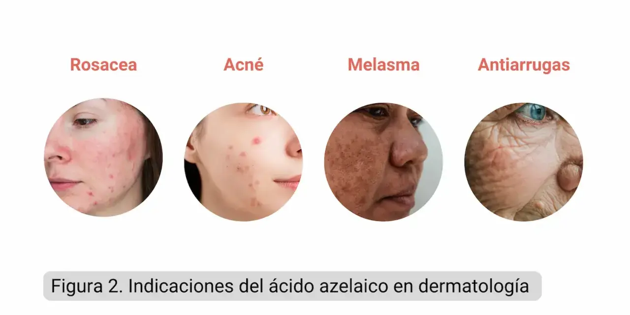 El ácido azelaico sirve para tratar rosácea, acné, melasma y arrugas, mostrando su versatilidad en dermatología.