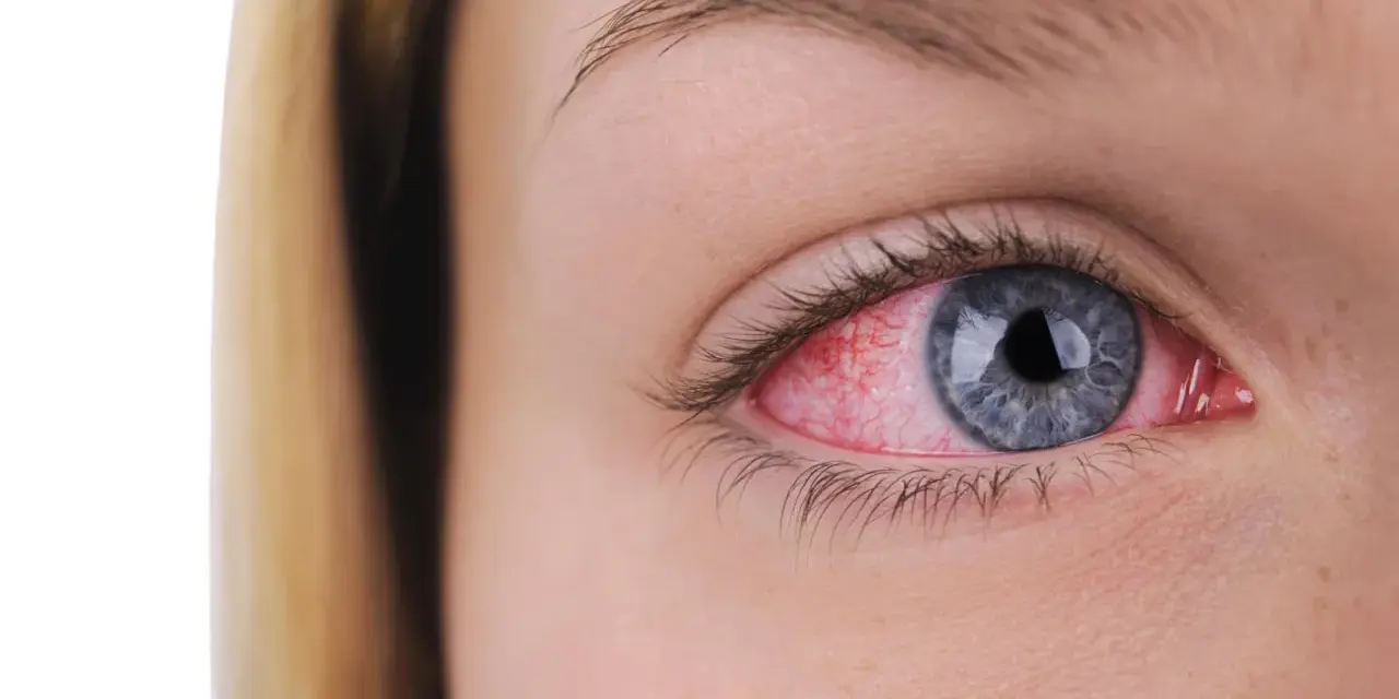 Occhio rosso e irritato, possibile sintomo di clamidia.