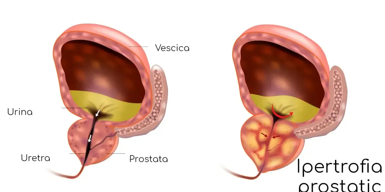 Confronto tra prostata normale e prostata infiammata, dove l'ipertrofia prostatica benigna comprime l'uretra, ostacolando il flusso urinario.