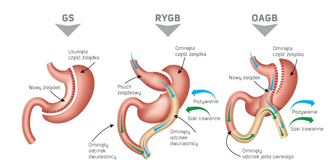 Ilustracja porównuje trzy typy operacji bariatrycznych: GS, RYGB, OAGB. Dowiedz się, ile kosztuje operacja bariatryczna i jakie są jej rodzaje.
