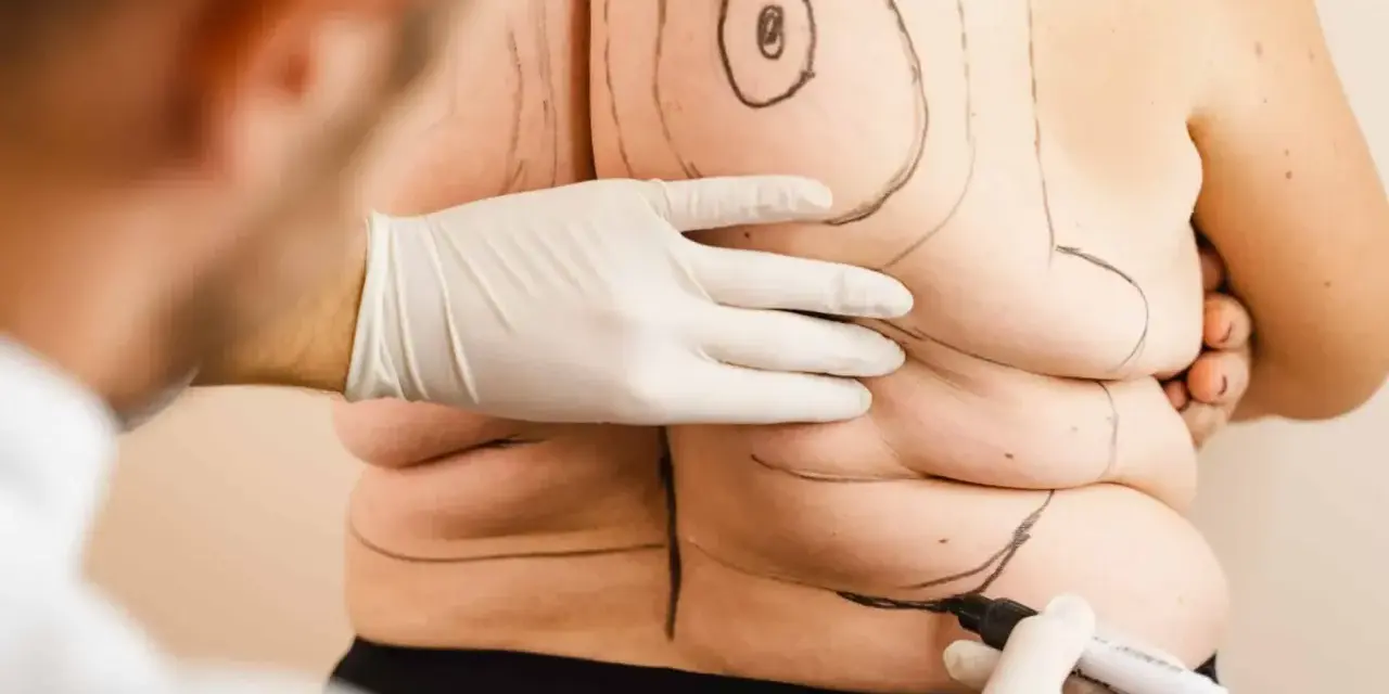 Liposukcja: Co to jest? Zrozum zabieg modelowania sylwetki