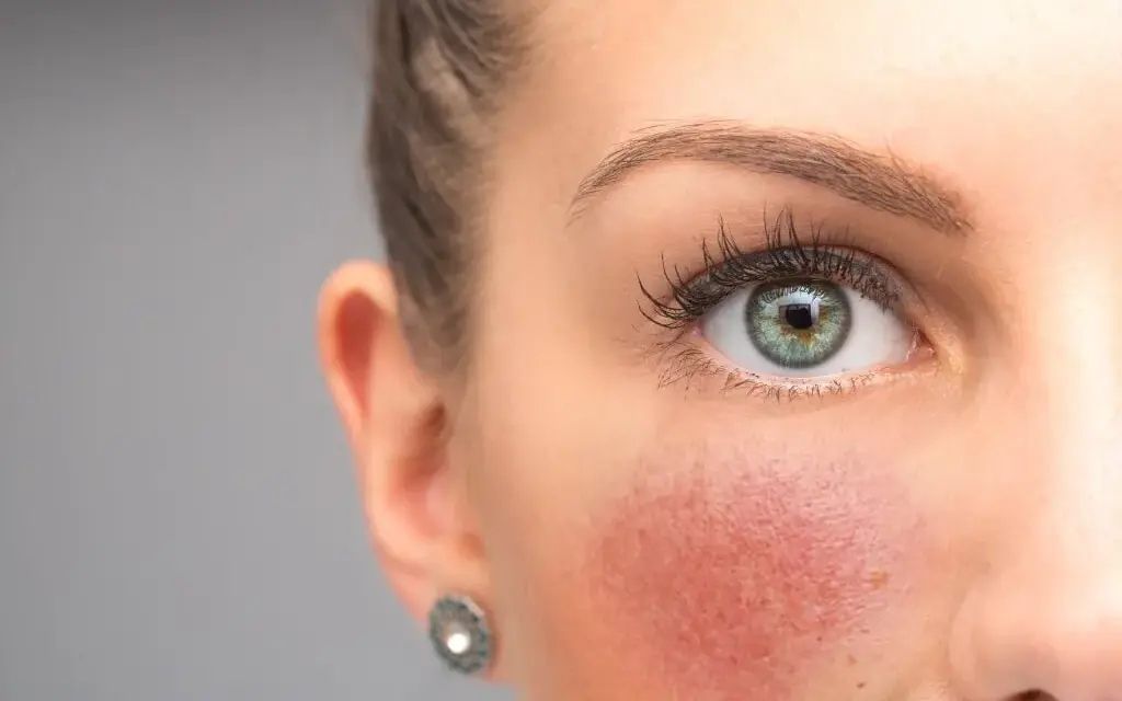 Was tun gegen rote Gesichtshaut? Effektive Tipps und Behandlungen