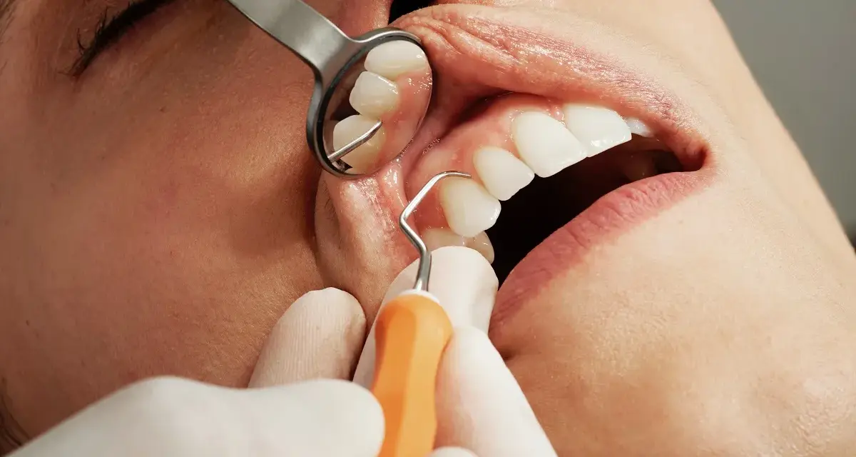 Próchnica: Kiedy domowe leczenie działa, a kiedy musisz iść do dentysty?