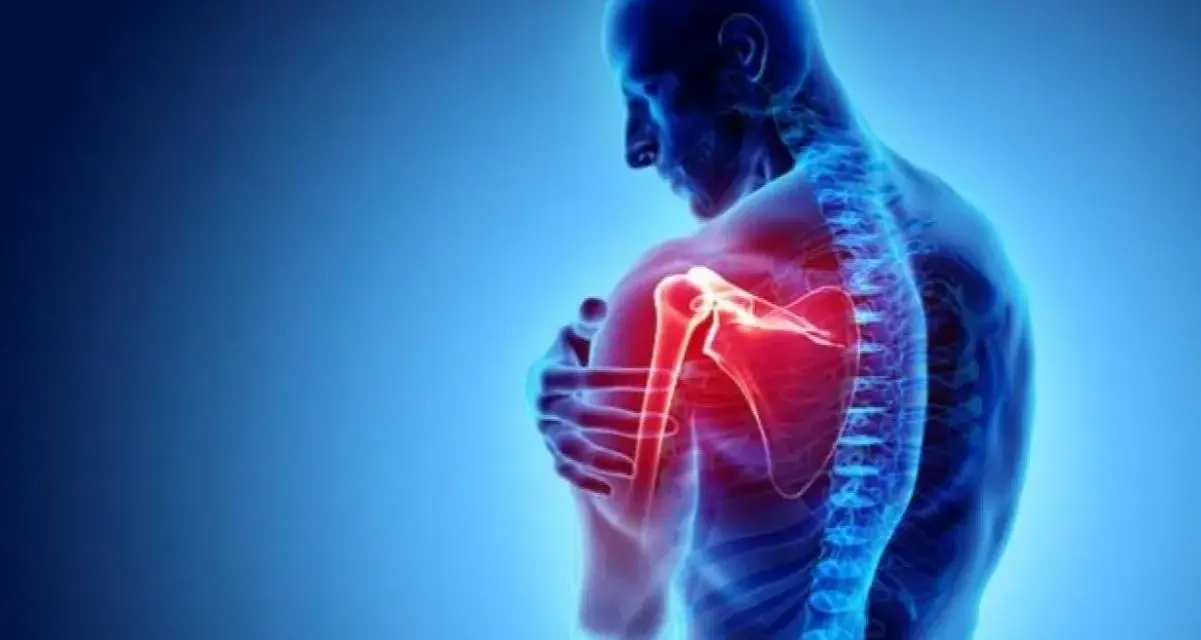 Anatomie d'un homme montrant une douleur vive à l'arrière de l'épaule, mise en évidence par une zone rouge intense.