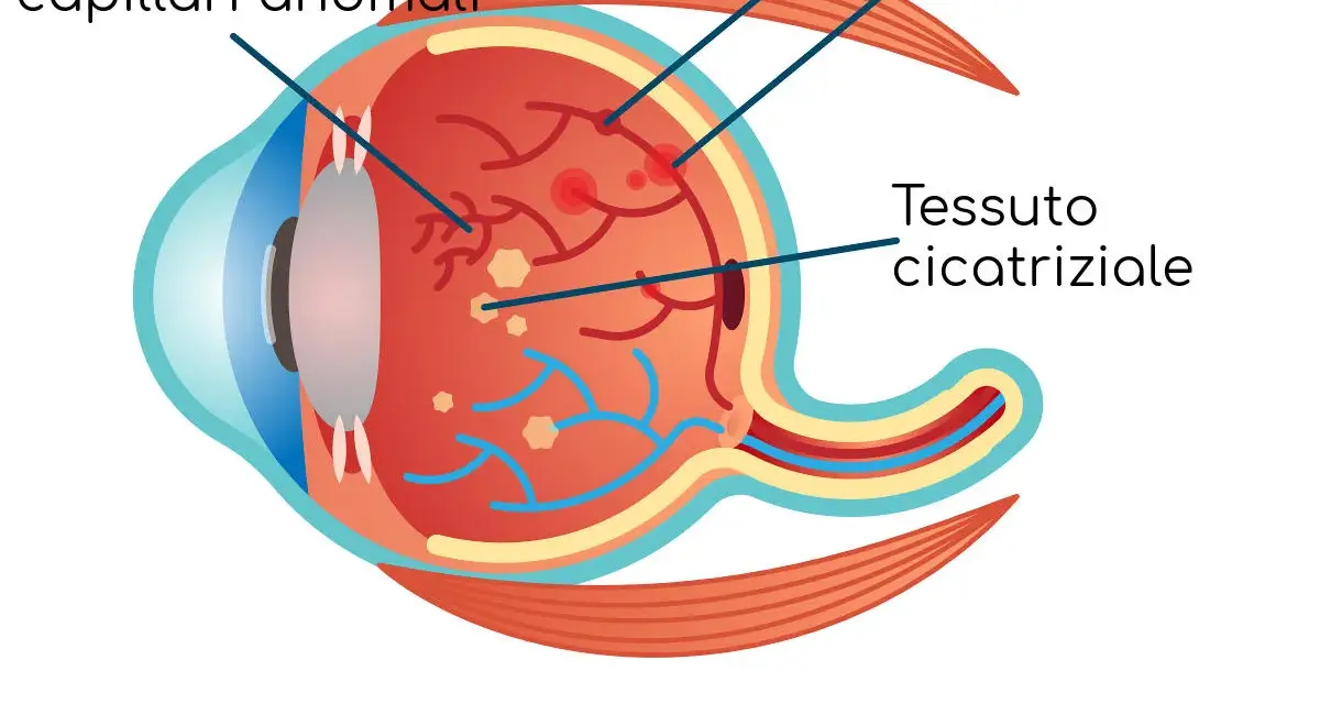 Illustrazione della retinopatia diabetica: sviluppo di capillari anomali, rigonfiamenti, emorragie retiniche che si riassorbono e tessuto cicatriziale.