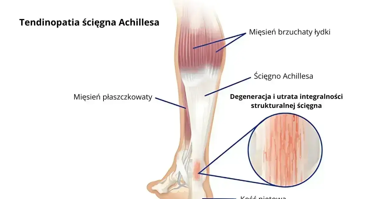 Anatomia podudzia człowieka z zaznaczonym ścięgnem Achillesa, mięśniami i kością piętową. Widoczna degeneracja ścięgna.