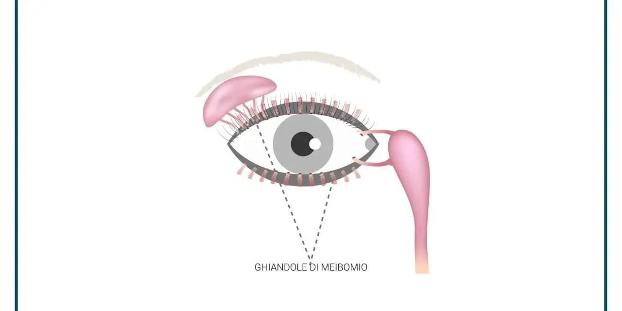 Illustrazione anatomica dell'occhio che evidenzia le ghiandole di Meibomio infiammate, responsabili della produzione del film lacrimale.