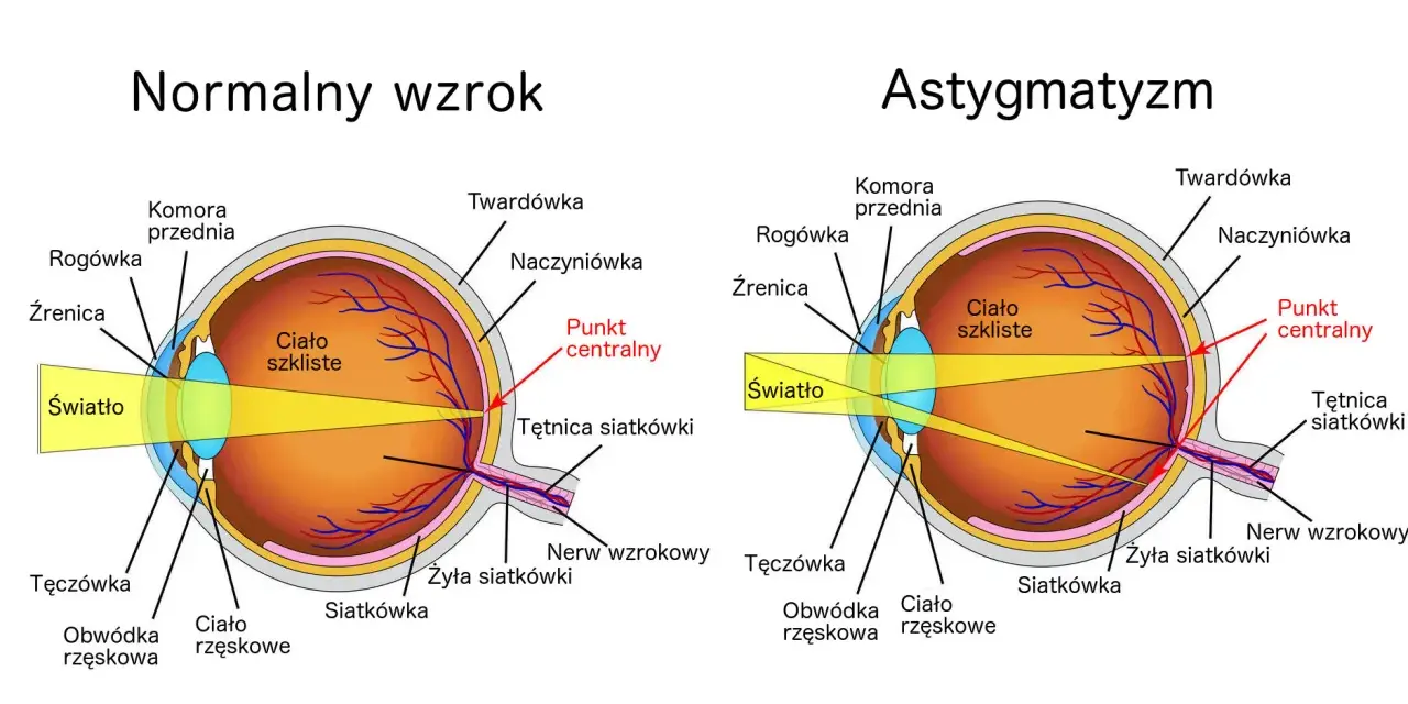 Schemat oka z normalnym wzrokiem i astygmatyzmem, pokazujący drogę światła i budowę narządu.