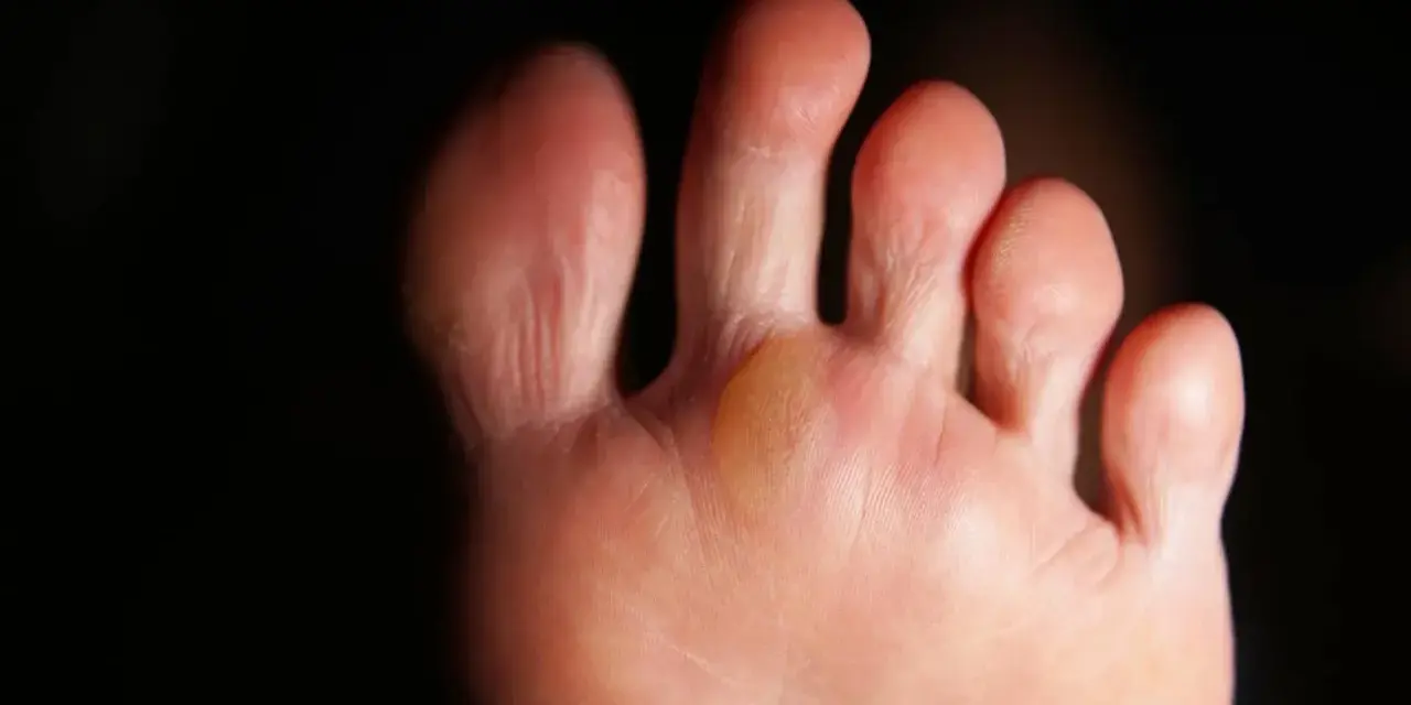 Gros plan sur un pied, montrant une phlyctène jaune entre deux orteils, signe d'une irritation due à la marche.
