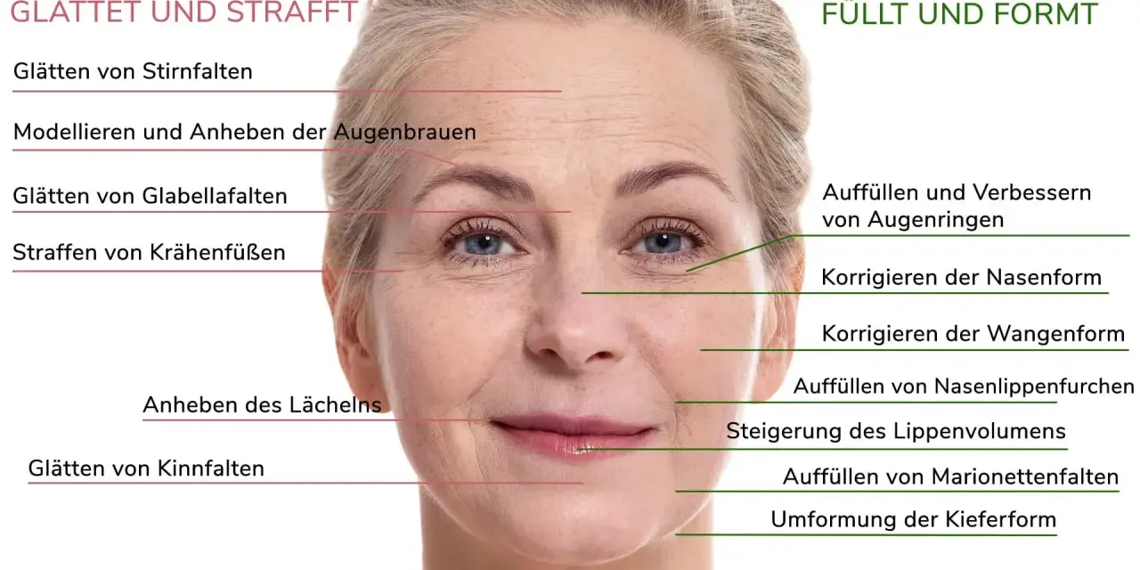 Gesicht einer Frau mit markierten Bereichen für Botox und Filler zur Behandlung von falten im gesicht, Stirnfalten, Krähenfüßen und Marionettenfalten.