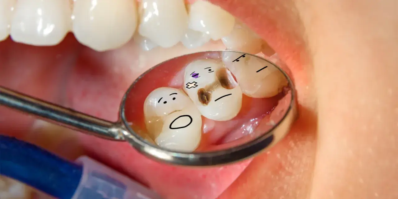 Zepsute zęby z narysowanymi buźkami w lusterku dentystycznym.