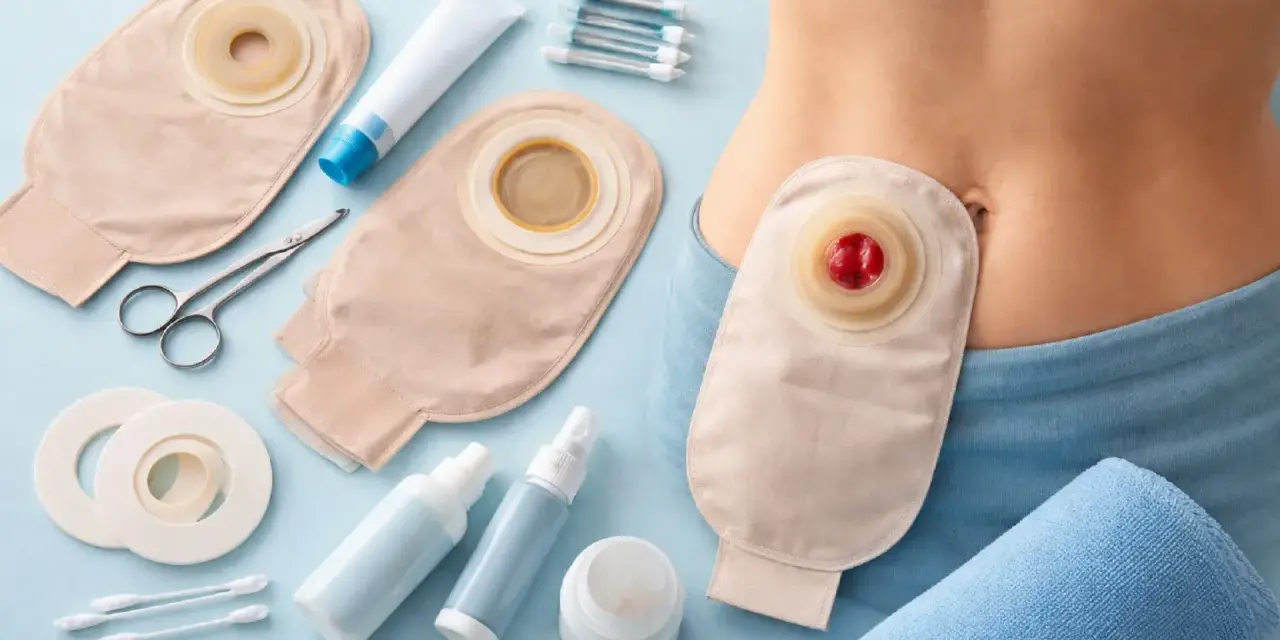 Urostomia: worek stomijny, akcesoria do pielęgnacji i fragment brzucha osoby.