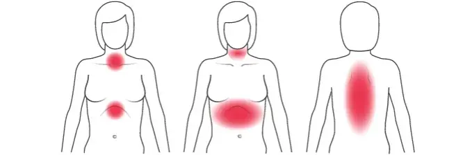 Herzinfarkt Frauen Symptome: Unterschätzte Anzeichen rechtzeitig erkennen