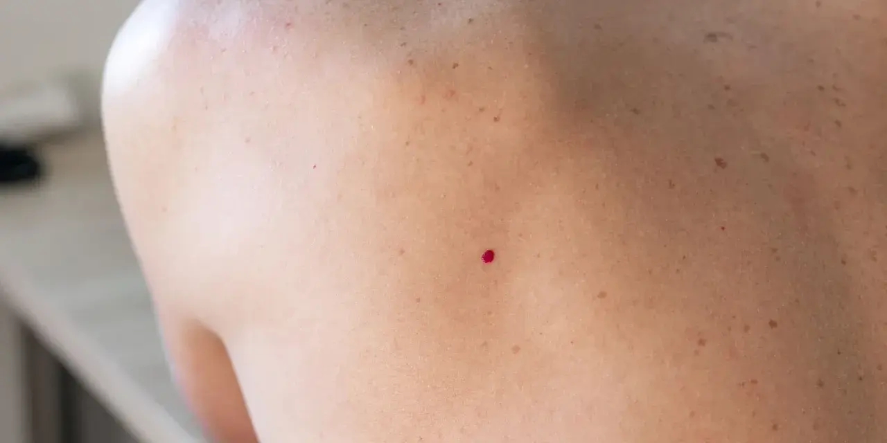 Zbliżenie na skórę pleców z widocznym naczyniakiem rubinowym.