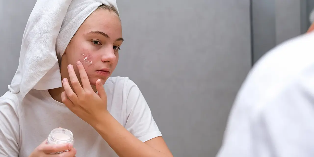 Mädchen mit Handtuch auf dem Kopf trägt Zinksalbe auf Pickel im Gesicht auf.