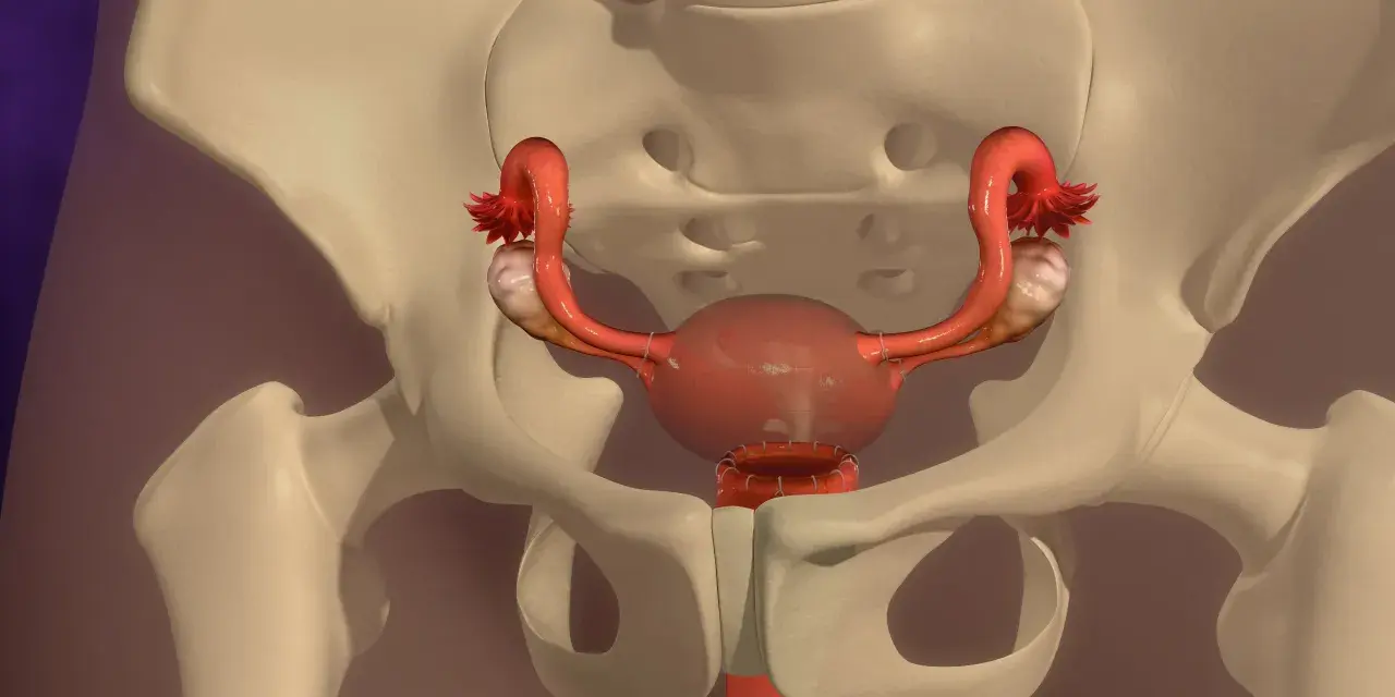 Anatomical model showing the female reproductive system within the pelvis. The uterus has undergone usunięcie macicy, with sutures visible at the cervical stump.