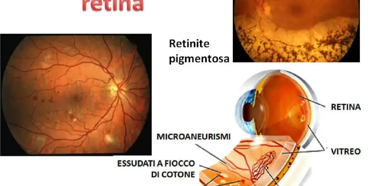 Immagini di malattie retiniche, tra cui la retinite pigmentosa e la retinopatia diabetica, che mostrano difetti dell'epitelio pigmentato retinico, emorragie e vasi sanguigni alterati.
