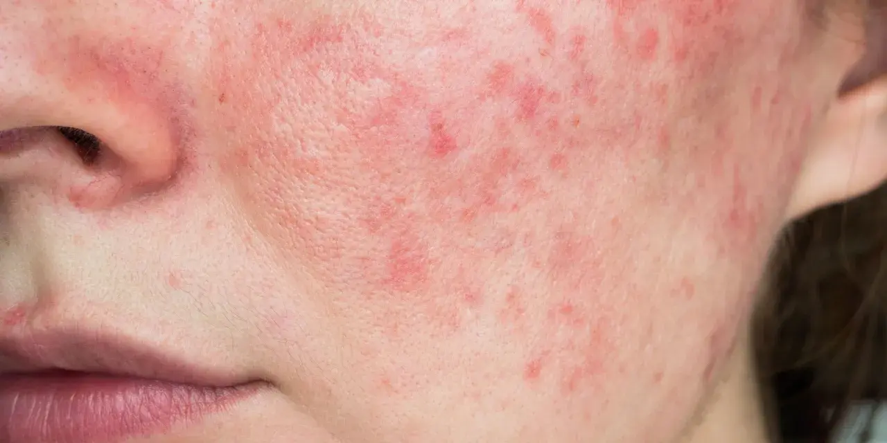 Primo piano del viso con evidenti rossori e imperfezioni cutanee, che suggeriscono una condizione come la rosacea o l'acne.