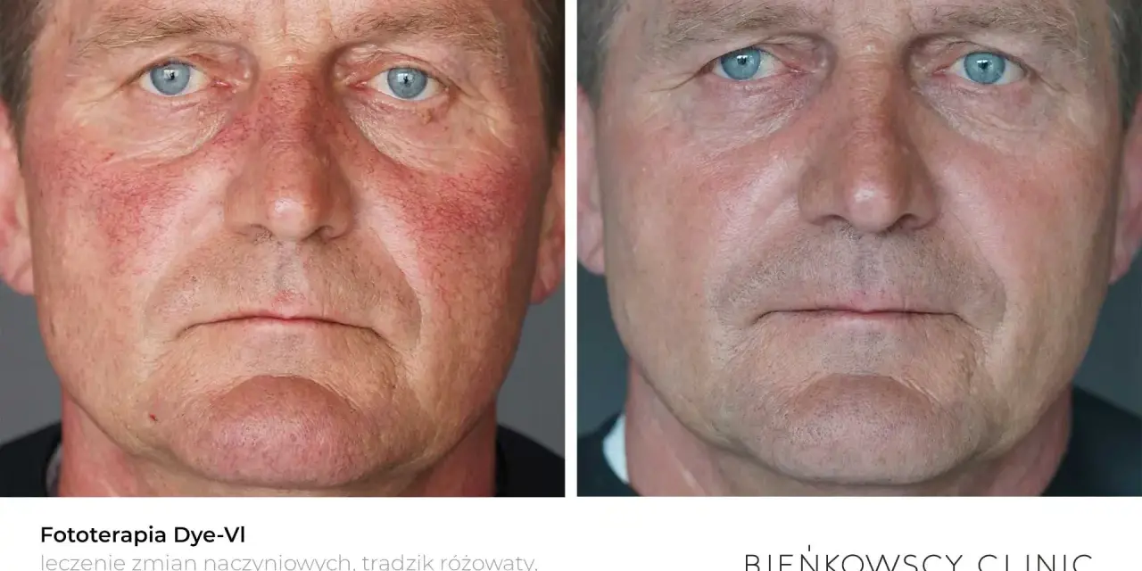Przed i po fototerapii Dye-VI: widoczna poprawa rumienia i zmian naczyniowych, skuteczna w leczeniu trądziku różowatego u mężczyzn.