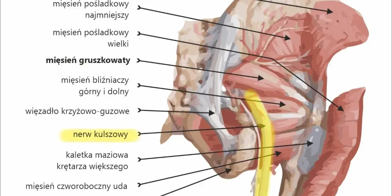 Anatomia miednicy: wbicie igły w nerw kulszowy, przebiegający obok mięśnia gruszkowatego.